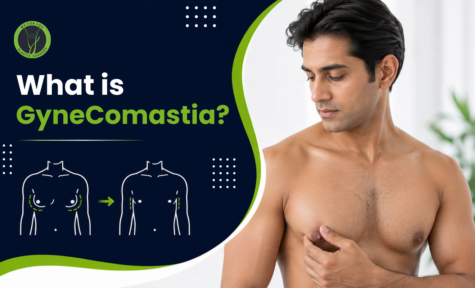 What Is Gynecomastia? A Complete, Honest Guide for Men Considering Surgery